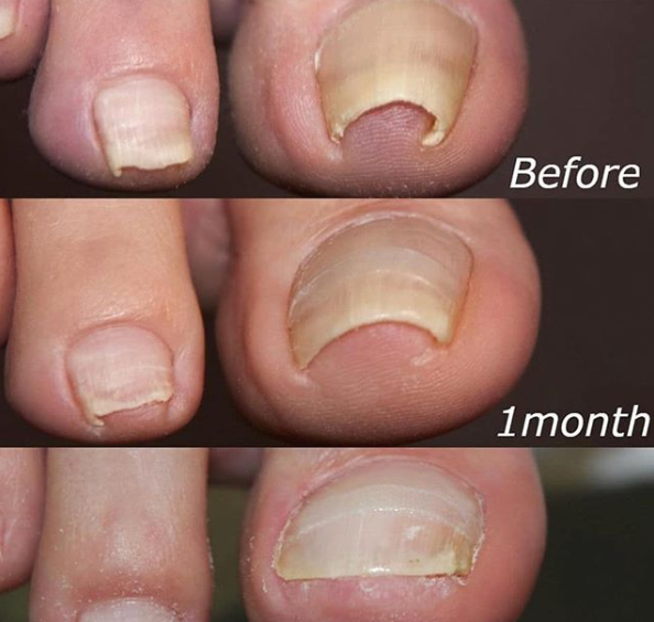 Giftzore™ Nail Correction Patches